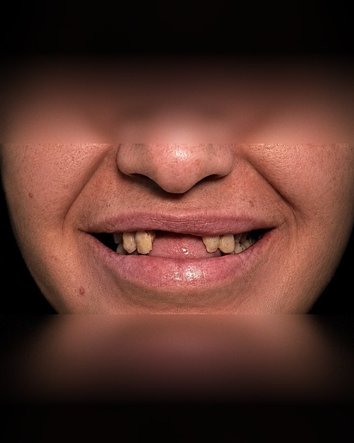 Antes da reabilitação com protocolo fixo sobre implantes