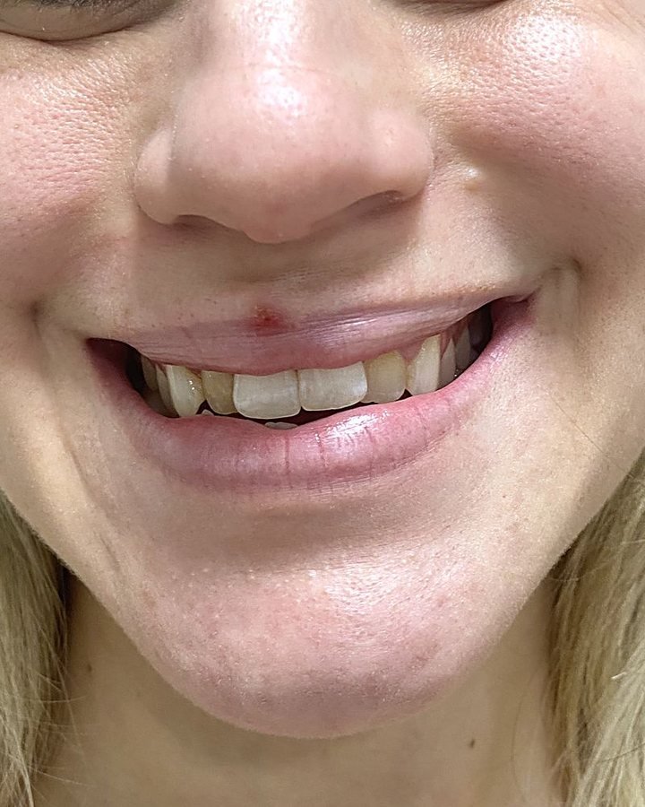Antes do tratamento com Invisalign: dentes desalinhados