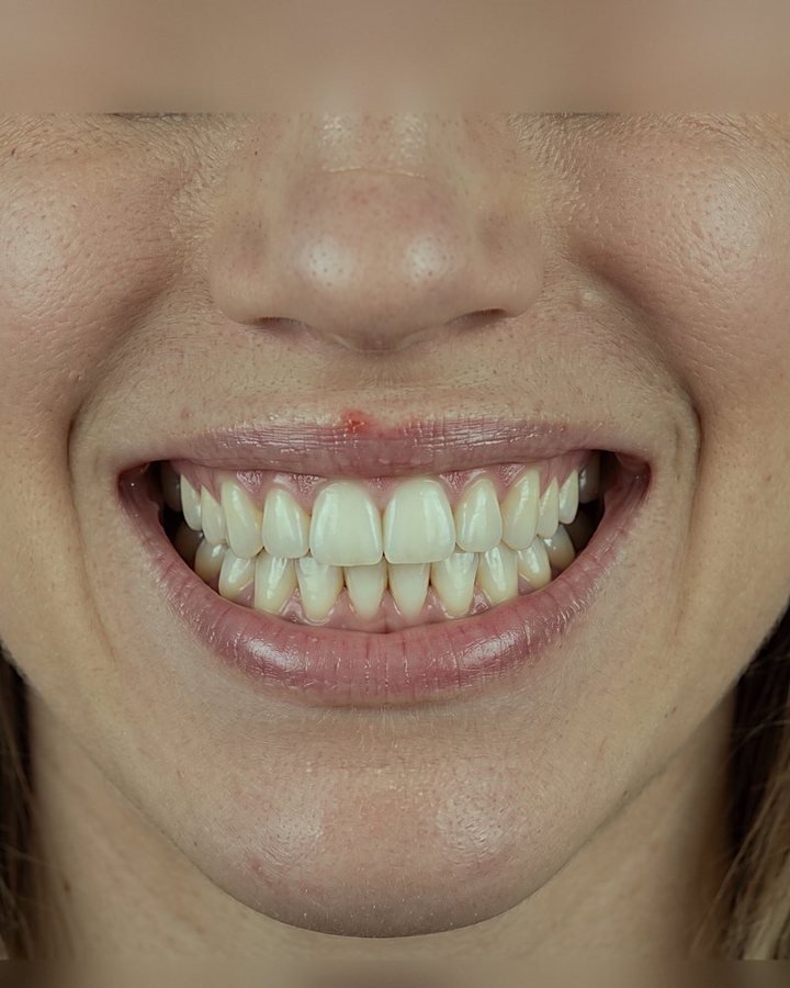 Depois do tratamento com Invisalign: dentes alinhados