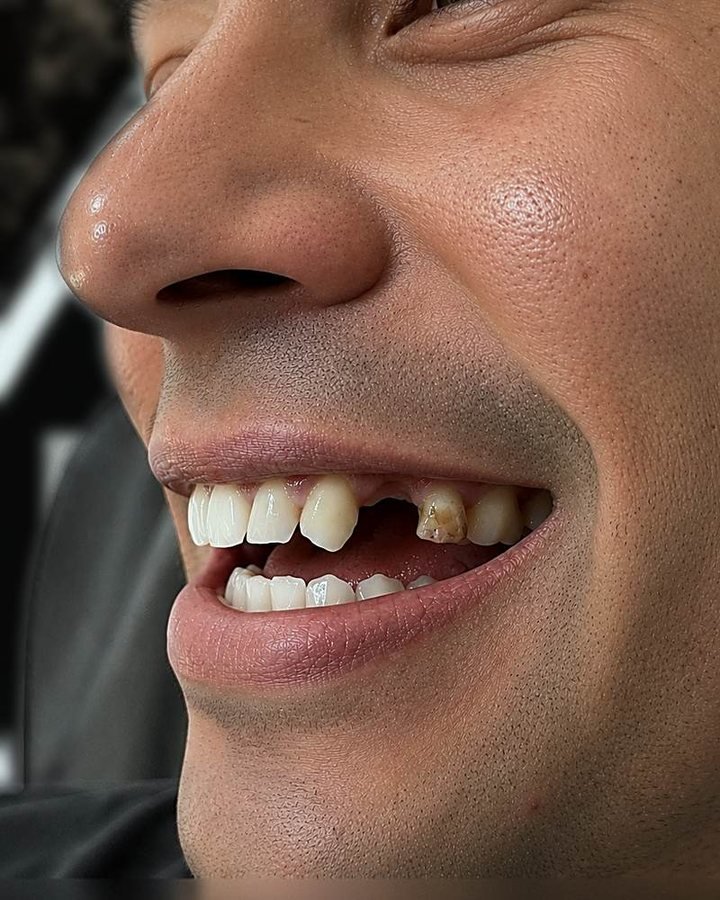 Antes do implante dentário: espaço de um dente perdido