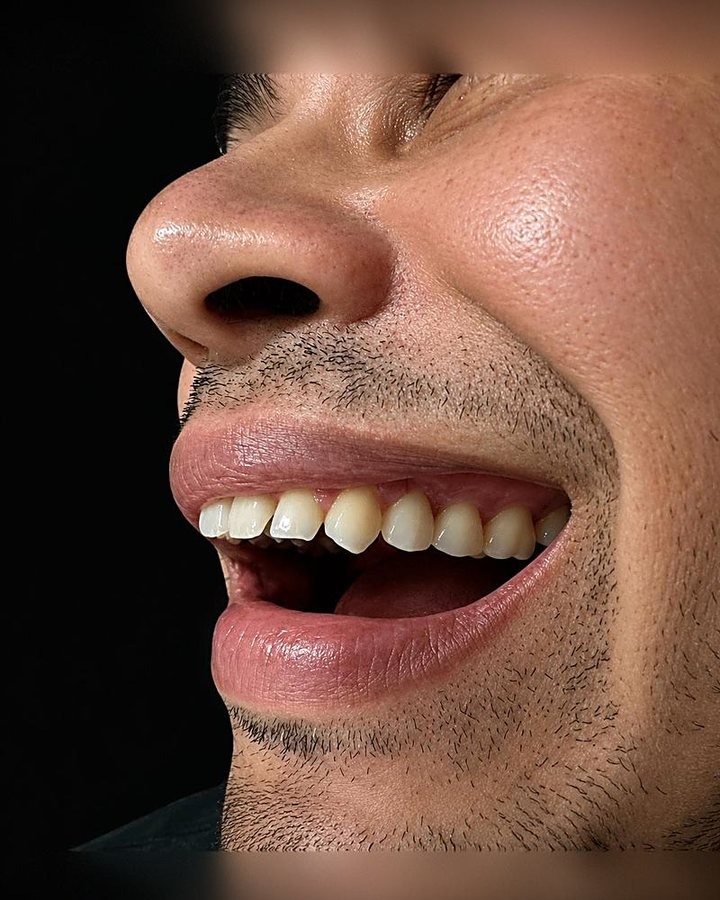 Depois do implante dentário: coroa instalada no lugar do dente perdido