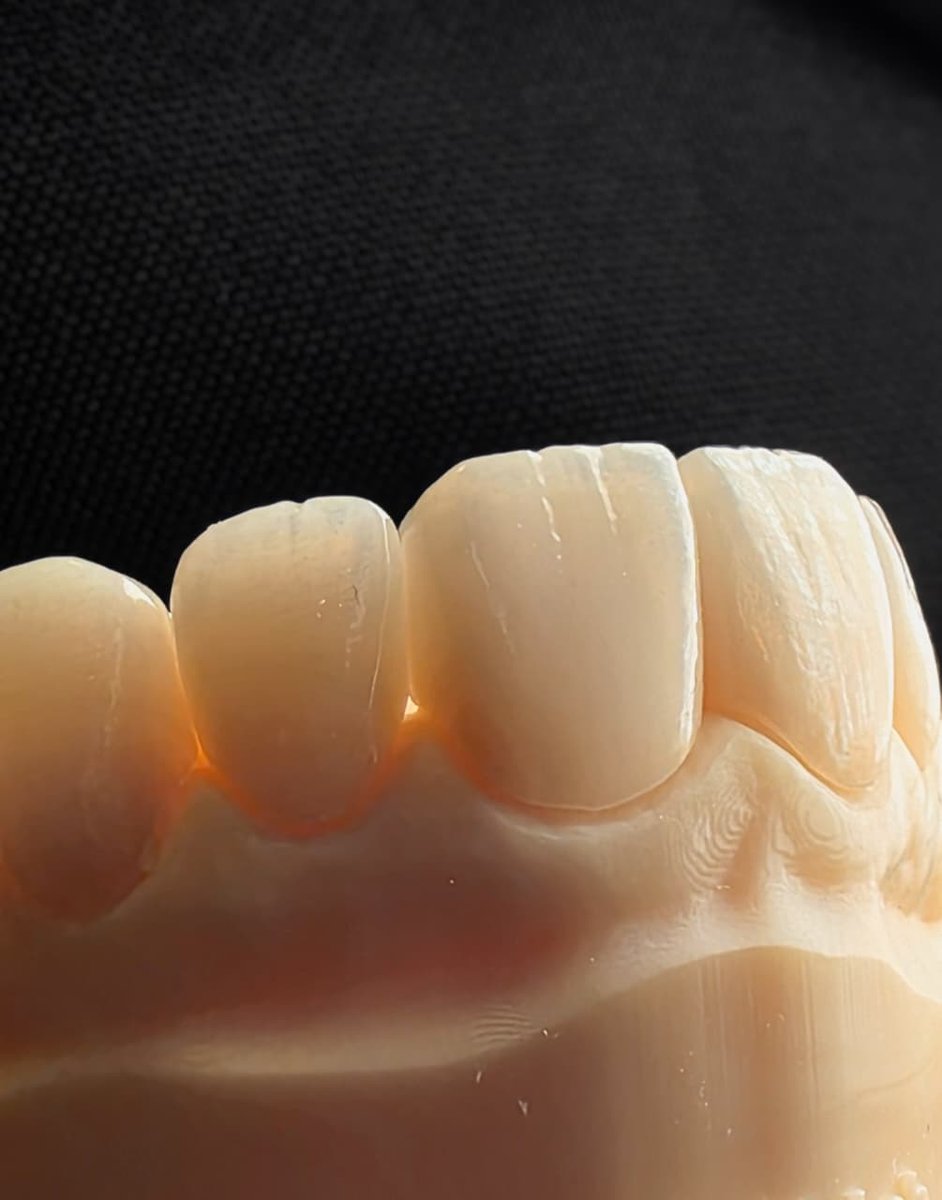Lente de contato dental de porcelana ultrafina segurada com pinça