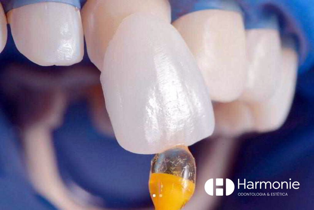 Lente faceta dental em são josé dos pinhais