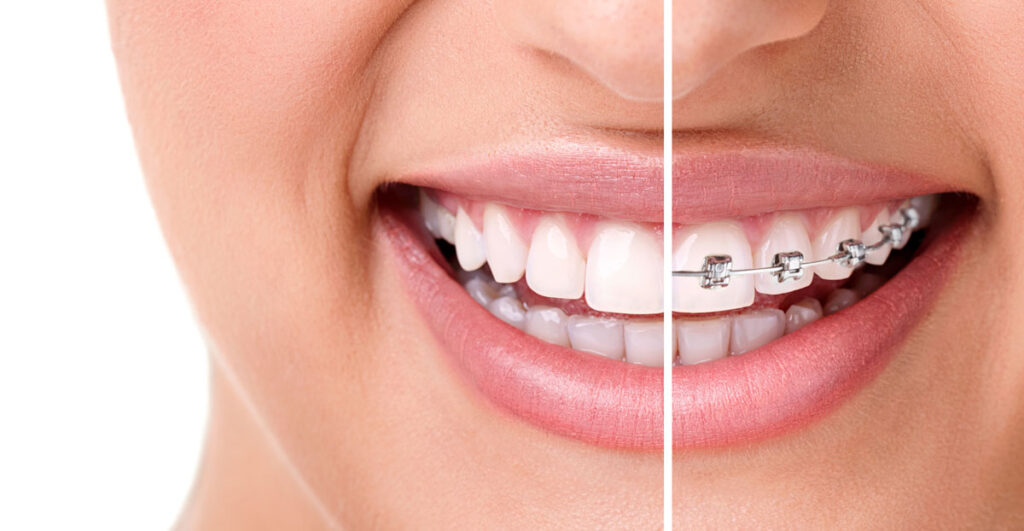 Aparelho fixo em são josé dos pinhais